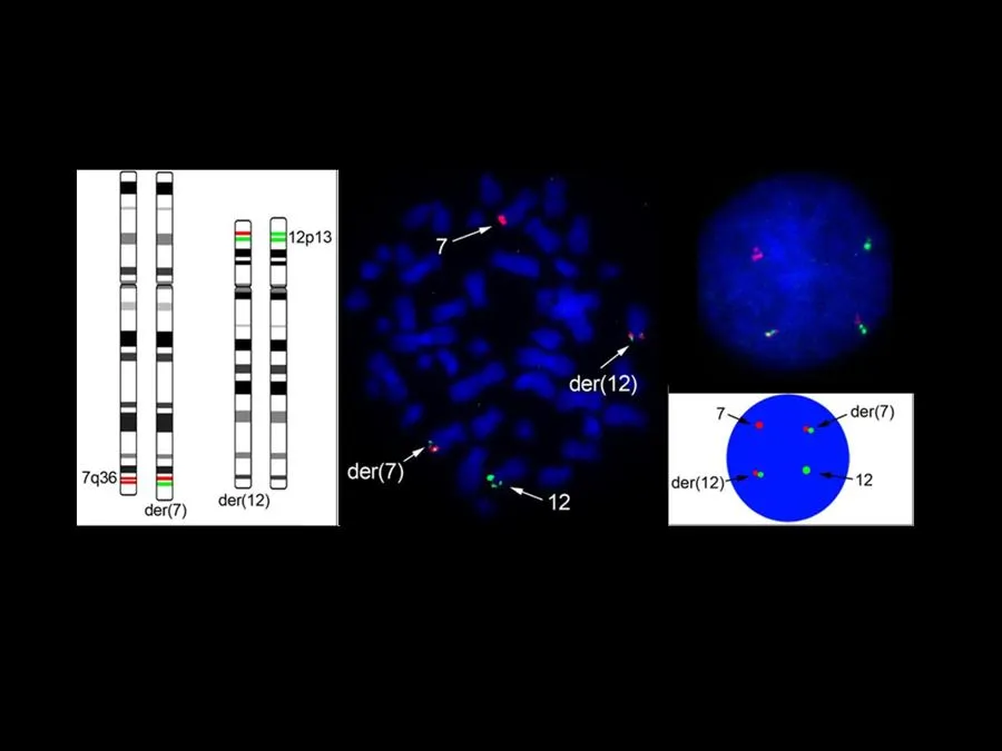 The use of fluorescence microscopy enabled us to detect a genetic rearrangement between chromosome 7 and chromosome 12 in the leukaemia cells of infant patients. In this picture, you can see (A) the ideograms of chromosomes 7 and 12 (both normal and rearranged) - the presence of green and red signals together indicates the rearrangement on the abnormal (der) chromosomes; (B) a metaphase spread where the chromosomes are visible in condensed form and tagged with fluorescent probes; (C,D and E) examples of interphase nuclei where chromosomes are not visible because are decondensed (in these images you can still see fluorescent patterns that allow you to identify the translocation when green and red signals are close to each other); (F) a schematic representation of probe combinations in the interphase nucleus. Link to the publication: http://dx.doi.org/10.7243/2052-434X-3-4