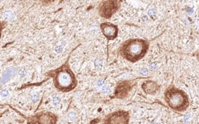 image of Experimental gene therapy raises hope for children with fatal neurological disease