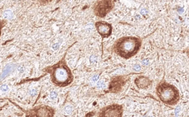 Gene therapy
