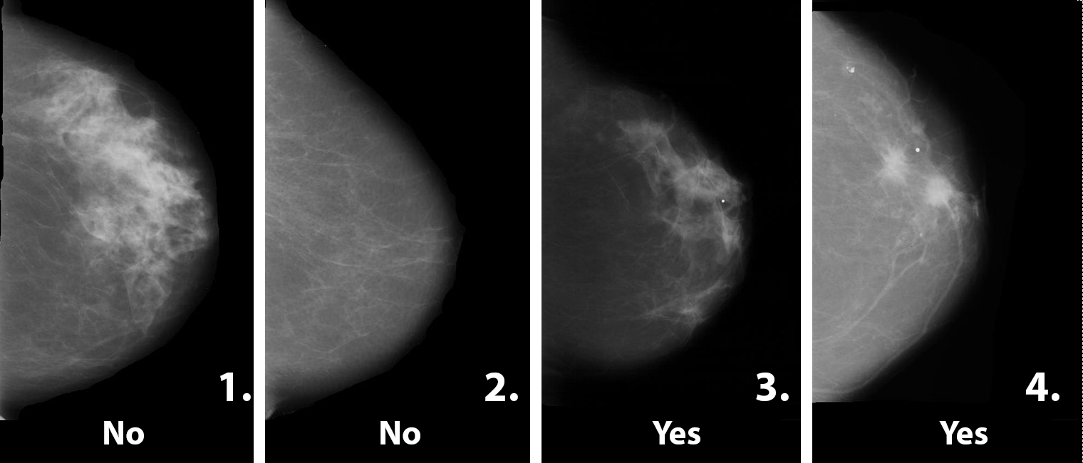 This image shows the answers to the sample mammogram screening task