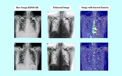 image of AI auto-scans lung X-rays for coronavirus