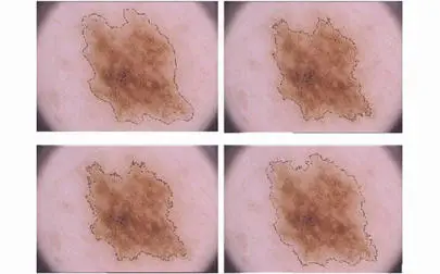 image of Pushing the boundaries of melanoma border detection