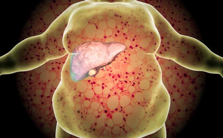 image of Liver fat directly linked to type 2 diabetes, new study shows