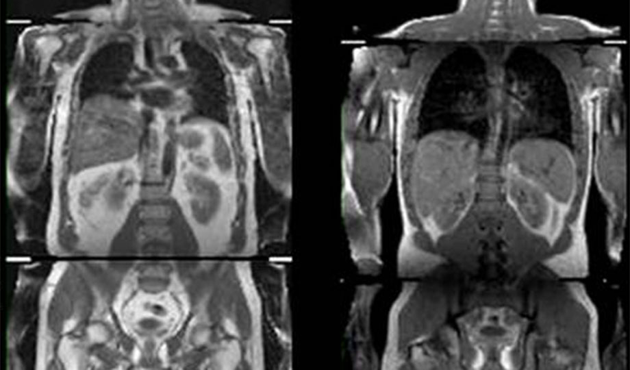 factors tied to obesity may protect against diabetes Brunel