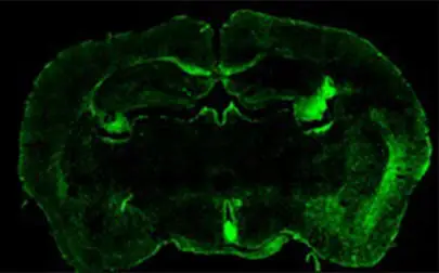 image of Lethal brain tumour shields itself from immune attack