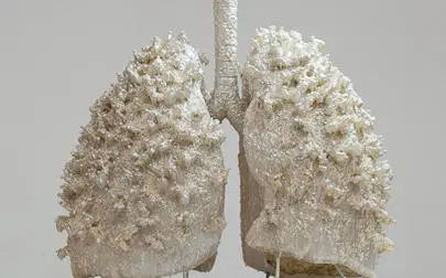 image of Cerebral palsy patients' lung disease death risk 14 times higher