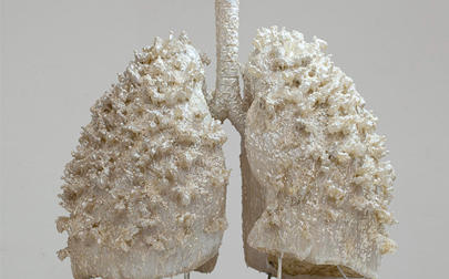 image of Cerebral palsy patients' lung disease death risk 14 times higher