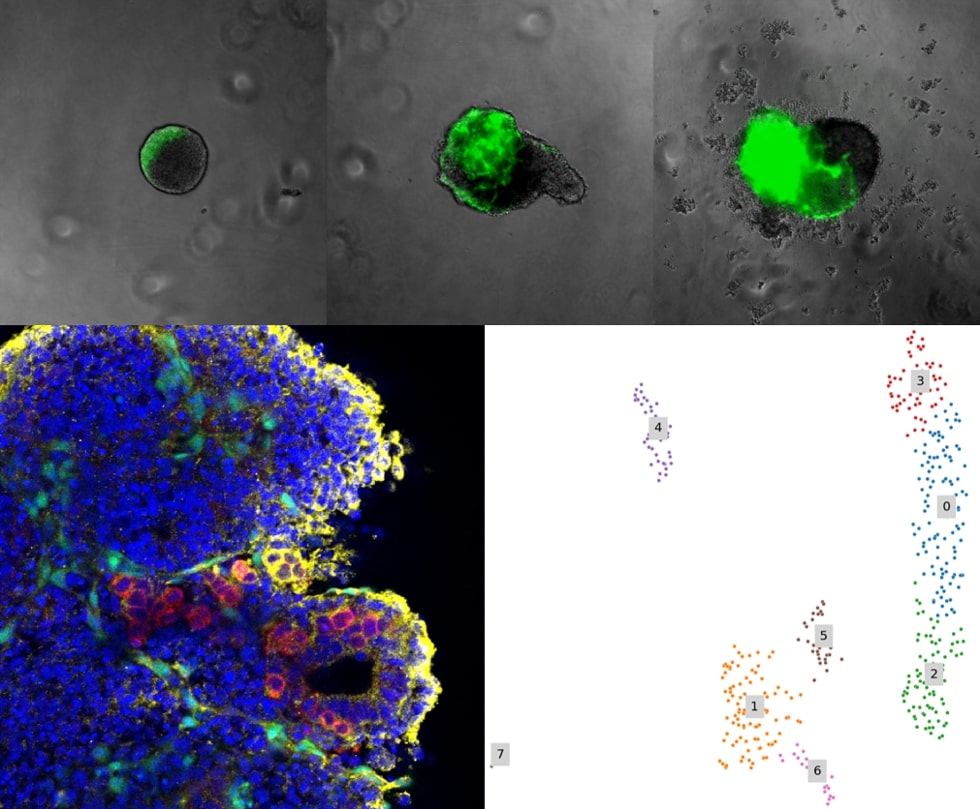 The panels represent a 3-dimensional model of foetal blood formation, built from mouse embryonic stem cells. We call these models haemogenic, or blood-forming, gastruloids.The mouse embryonic stem cells have been engineered to express a green fluorescent protein (GFP) gene in blood vessel-lining endothelial cells, some of which specialise to form blood cells, including blood stem cells. The top 3 panels show emergence of the first GFP-positive endothelial cells and progressive development of GFP-positive vascular networks in haemogenic gastruloids. Photographs were obtained at 4, 6 and 8 days of culture in the laboratory.At the bottom left, emergence of blood cells from the GFP-positive endothelial cells was captured by confocal microscopy. Round cells pseudo-coloured in red can be observed in bunches, or clusters, adjacent to flat endothelial cells shown in green. The arrangement closely mimics budding of blood cells in vivo from the vessel-lining endothelium. Round cells are labelled with an antibody against a molecule present in all blood cells, named CD45. Some of the CD45-positive cells are also pseudo-coloured yellow: this reveals the presence of another molecule named C-Kit, characteristic of immature blood cells, including blood stem cells. Blue stains all types of cells formed in the gastruloid model.Bottom right depicts a detailed analysis of the genes expressed by all blood and endothelial cells present in the day 8 haemogenic gastruloids. Gastruloids were dissociated into individual cells, and each cell was sequenced to catalogue the genes it expresses – this is called single-cell RNA sequencing, and informs our understanding of the identity and function of each cell. Individual cells are represented on a plot, where each dot corresponds to a single cell. Cells expressing similar genes in similar amounts are represented together in groups, or clusters, which are numbered. Endothelial GFP-positive cells are present in clusters 0 and 3, and blood CD45-positive cells are in clusters 1, 4, 5, and 6, with the most immature cells present in cluster 4.We are investigating cluster 4 cells for the presence of blood stem cells, which may be later expanded and used in bespoke bone marrow transplants.