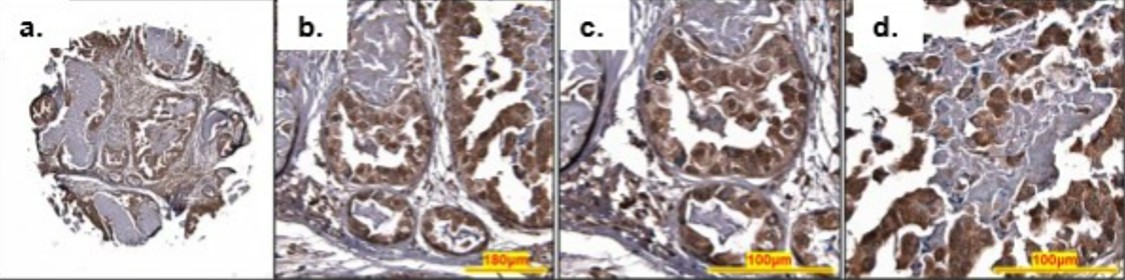 Treating breast cancer, Dr Amanda Harvey