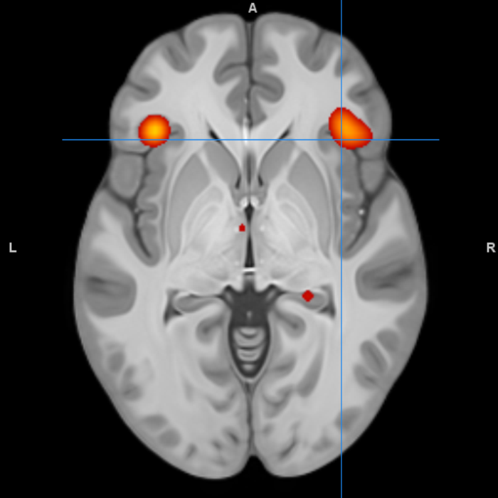 brain scan