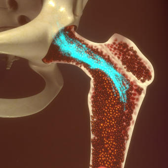 Modelling internal bone marrow dose from Radium-223
