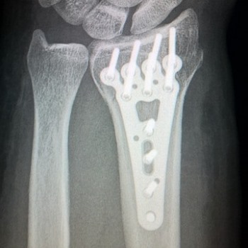 broken-arm x ray